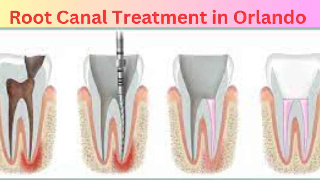 Root Canal Treatment